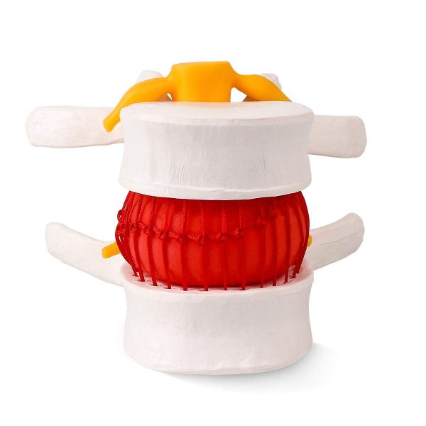 Human Anatomical Lumbar Disc Herniation Model - Lumbar Spine Model for Teaching & Learning - Excellent Way for Demonstrating Disc - Image 2