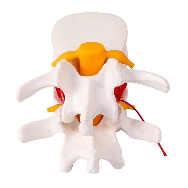 Human Anatomical Lumbar Disc Herniation Model - Lumbar Spine Model for Teaching & Learning - Excellent Way for Demonstrating Disc - Image 5