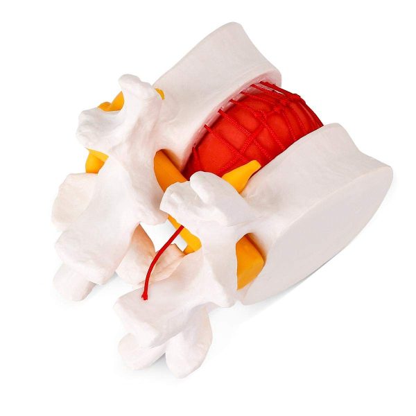 Human Anatomical Lumbar Disc Herniation Model - Lumbar Spine Model for Teaching & Learning - Excellent Way for Demonstrating Disc - Image 4