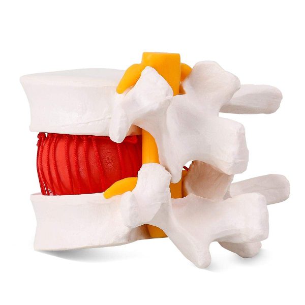 Human Anatomical Lumbar Disc Herniation Model - Lumbar Spine Model for Teaching & Learning - Excellent Way for Demonstrating Disc - Image 3