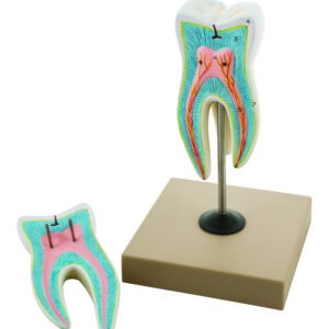EISCO Upper Triple Root Molar with Caries Model Enlarged 15 Times 2 Parts