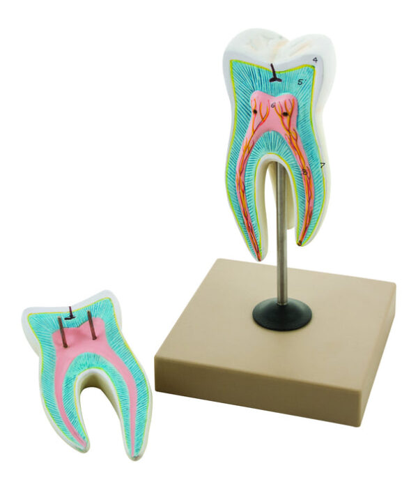 EISCO Upper Triple Root Molar with Caries Model Enlarged 15 Times 2 Parts