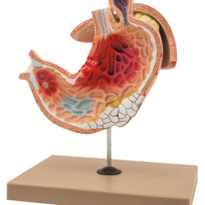 Stomach Ulcer
