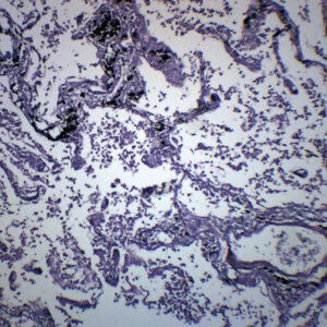 Pneumonia in Human Lungs - Prepared Microscope Slide - 75x25mm