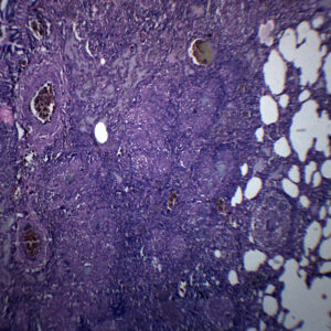 Tuberculosis, Human Lung Section - Prepared Microscope Slide - 75x25mm