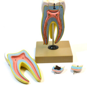 Eisco Labs Human Upper Triple Root Molar with interchangeable cavities - 6 parts