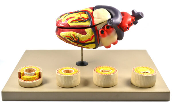 Eisco Labs Model of Human Heart Conditions Pathology; Larger than life size (10"); Artery Cross sections 2.5" in diameter