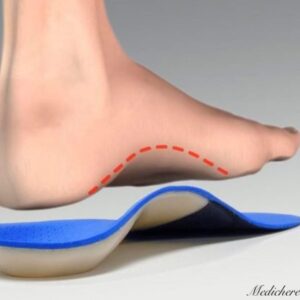 Flat foot,(pes planus) corrector