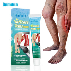 Varicose Veins Cream