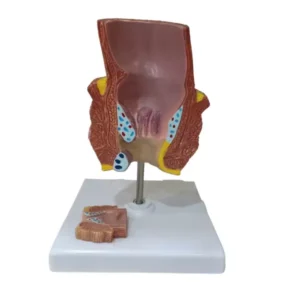 A-ONE SCIENCE Multicolor PVC Diseased Rectum Model AOSBM137