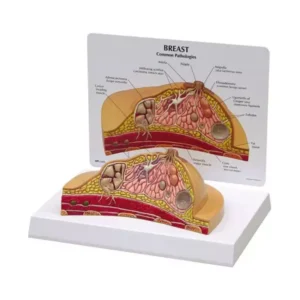 A-ONE SCIENCE Multicolor PVC Diseased Breast Model AOSBM167