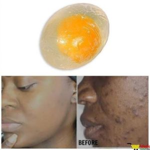 Egg Soap ? For Pimples Free/Sun Burn And Smooth Face